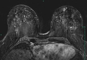 false positives mri breast How boobs grow